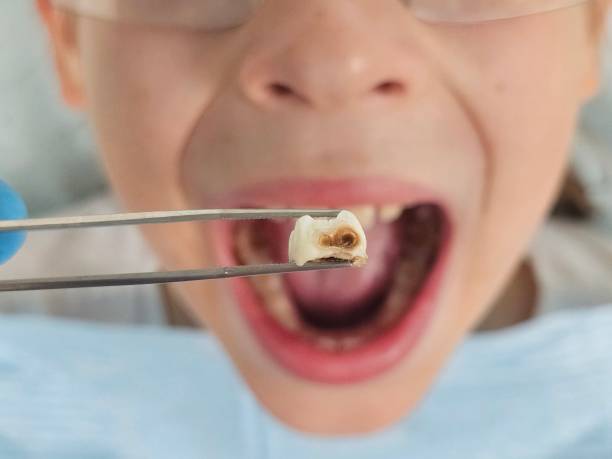 Best Emergency Wisdom Teeth Removal in Coord, NC